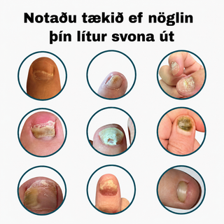 NuvoCare – Blá ljósmeðferð við naglasveppi heima
